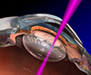 Ultrafast lasers for cataract surgery